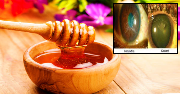 Scientists Discovered That Only Honey Can Treat Eye Diseases – Here’s How